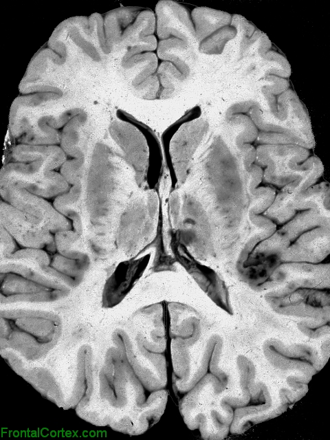 Thrombotic thrombocytopenic purpura, horizontal section of brain through basal ganglia.